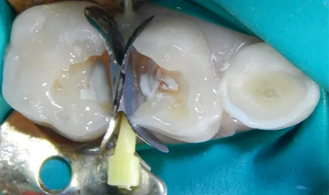SafeEndo ReCreate LC Flow